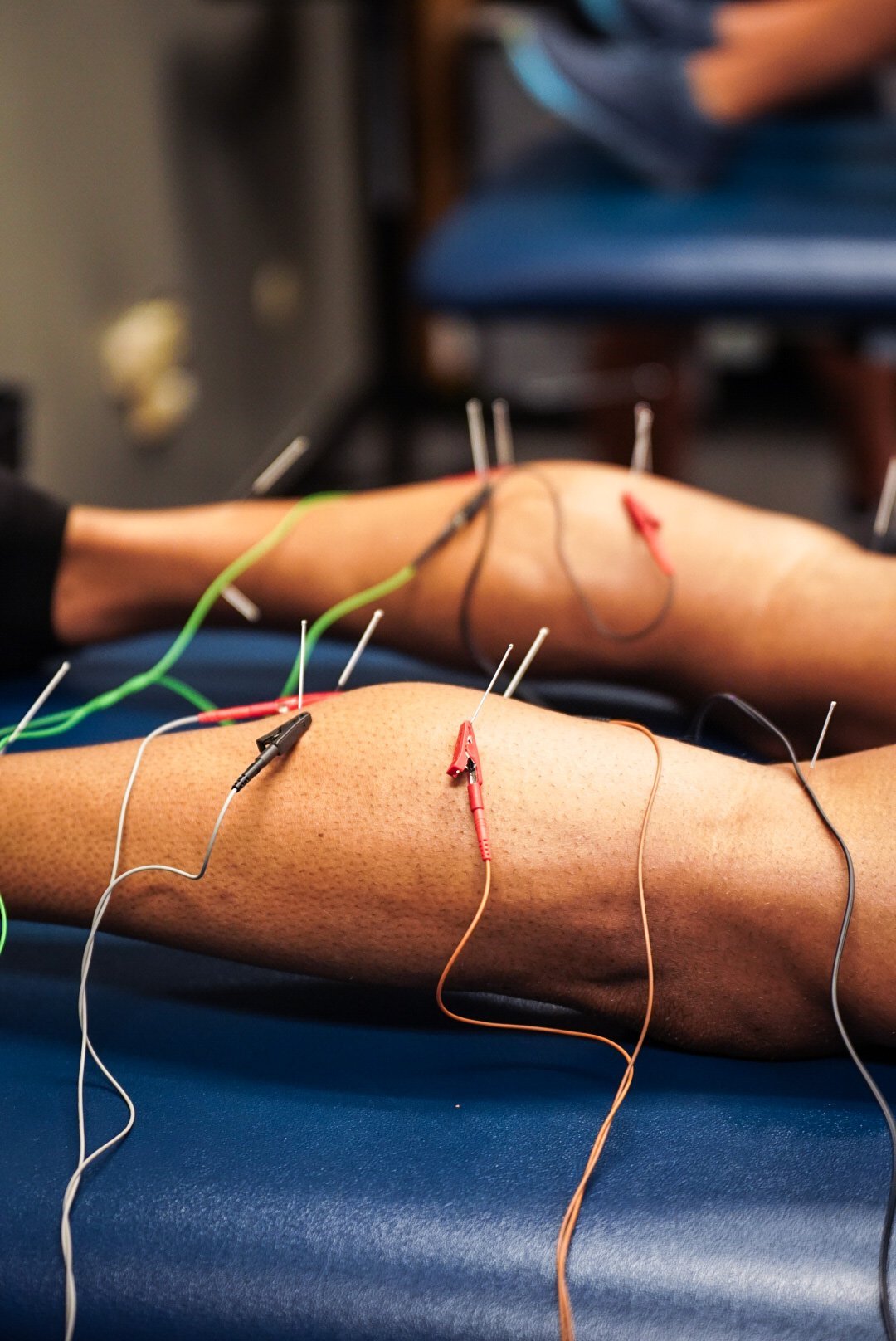 dry-needling-physical-therapy-gsouthern-nj