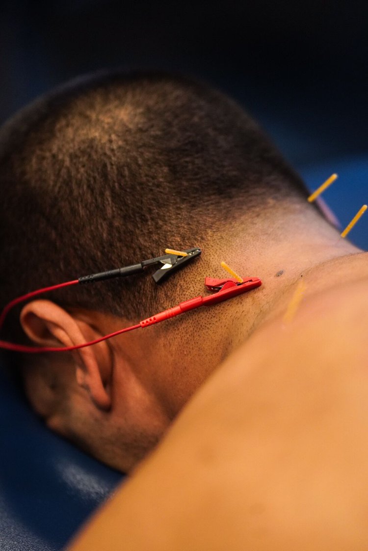 dry-needling-physical-therapy-southern-nj