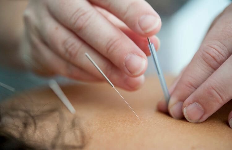 dry-needling-therapy-pain-relief-southern-jersey