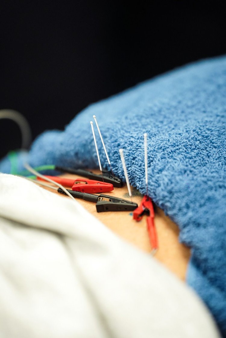 dry-needling-physical-therapy-southern-nj